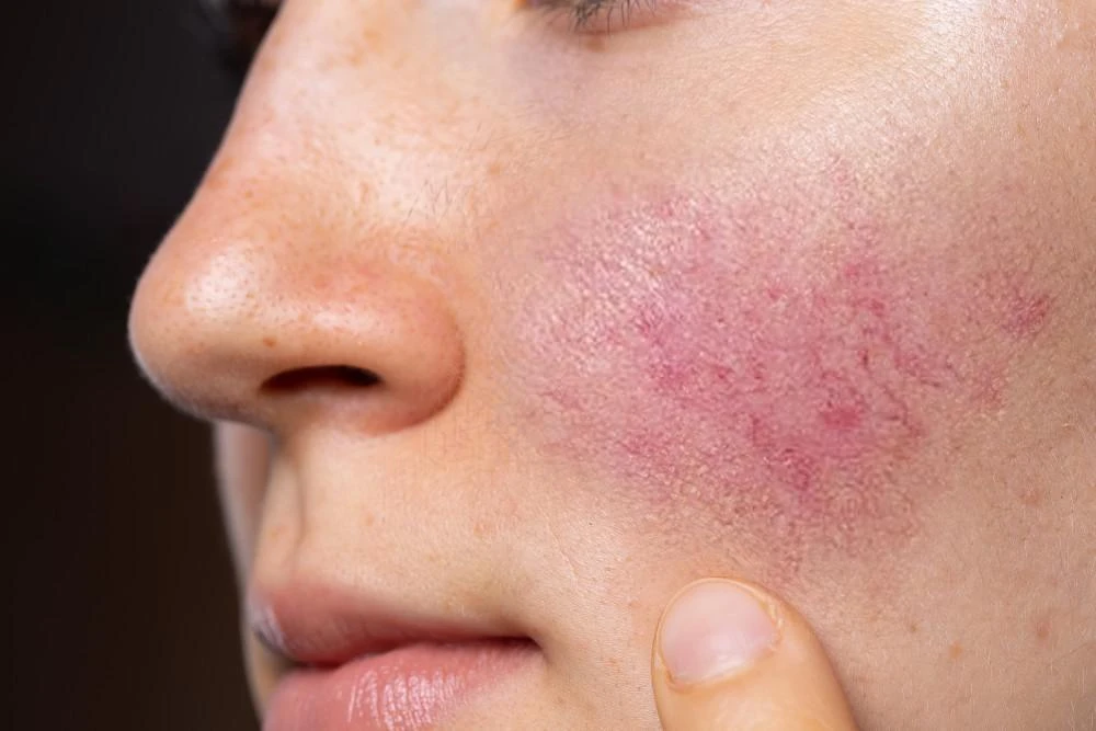 5 Common Rosacea Triggers