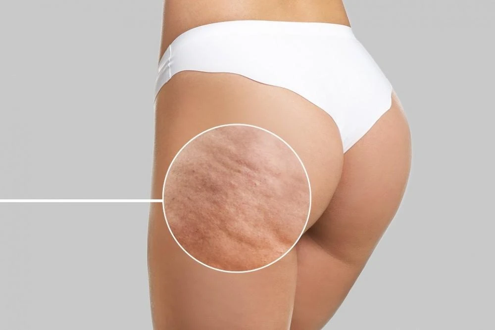 What's the Best Solution for Cellulite?